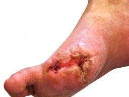 Obesity often accompanies diabetes and vascular disease, but the stress of extra weight alone can also compress arteries, leading to reduced blood flow and. Gangrene Causes Symptoms And Treatment