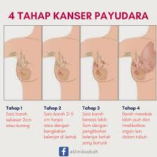 For more information and source, see on this link : Klinik Sabah Tahap Tahap Kanser Payudara Kanser Facebook