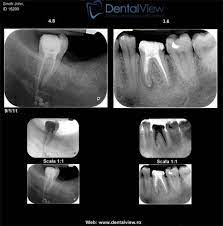 „radiografiile dentare joacă un rol foarte important în diagnosticul afecțiunilor dentare. Yts Dental View Laborator Radiologie Dentara Sector 1 Bucuresti
