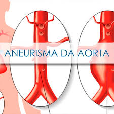 O que é a artéria aorta? O Que E Um Aneurisma Da Aorta Lobatocirurgiavascular Com Br