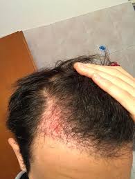 Più del 79% degli uomini verrà colpito . La Mia Esperienza Con Il Trapianto Di Capelli Estheticon It