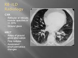 Both rbild and dip may have alveolar spaces filled with macrophages, the airspaces in dip. Pulmonology Case Presentation Dr Gj Visagie Patient 43