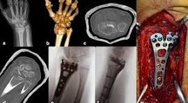 a–d Distal radius fracture with involvement of the radial ...