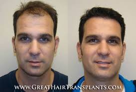 Male Pattern Hair Loss Treatment in Maryland Charles Mount Air
