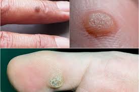 Kutil atau dalam bahasa malaysia disebut ketuat dapat muncul pada satu atau lebih di berbagai bagian tubuh, seperti pada telapak kaki, tapak tangan, area leher. Ketuat Pada Kulit Ketuat Adalah Dr Zubaidi Hj Ahmad Facebook