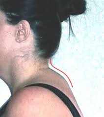 A neck hump is also known as a buffalo hump or a dowager's hump. The Multifactorial Causes And Solutions To Chronic Neck Pain Msk Neurology