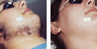 Medical spas, laser hair removal, reiki. Laser Hair Removal Before And After Photos Usha Rajagopal Md