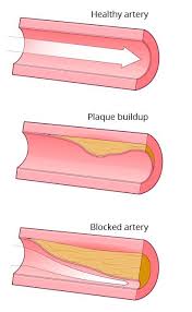 Causes Of Coronary Artery Disease