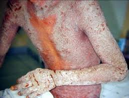 Image result for scabies norvegica