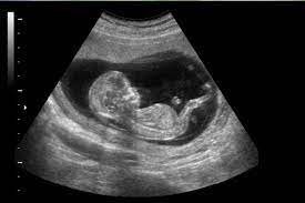 Maybe you would like to learn more about one of these? Embarazo Normal Ecografia Ginecologica Y Obstetrica Seguimiento Ecografico