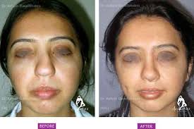 Is it possible to get dimples at home? Dimple Surgery At Pune S Number 1 Clinic Now You Can Get A Beautiful Smile Too