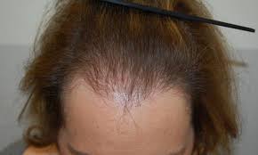 Microneedling for hair loss has shown a lot of promise in recent years and seems to cause. Female Androgenetic Alopecia An Update On Diagnosis And Management Springerlink