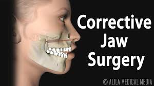 Put you fingers on the back teeth as far as possible and you thumbs under the front of the chin. Corrective Jaw Orthognathic Surgery Animation Youtube