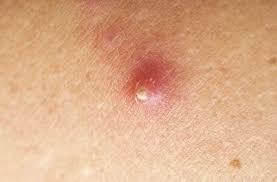 Karena biasanya mengatasi jerawat bisul memerlukan. Petua Cara Merawat Bisul Yang Mudah Diamalkan