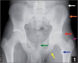 Image result for Hip Apophysitis