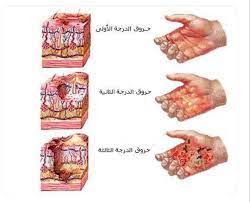 طريقة ازالة اثار الحروق من الجسم مجلة رجيم