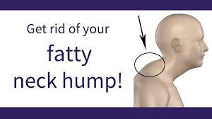 She has not started her period yet but surely that doen't have anything. Posture Coach Tells How To Get Rid Of Neck Hump Neck Hump Neck Exercises Posture Exercises