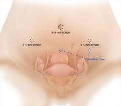 Such complications commonly include infection, hemorrhage, vaginal vault prolapse, and injury to the ureter, bowel, or bladder. Understanding Laparoscopic Hysterectomy Women S Healthcare Associates