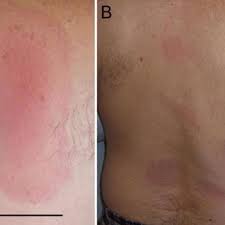 The red rash, also known as the 'erythema migrans' (em), is one of the most famous symptoms of lyme disease. Symptoms Of The First And Second Stage Of Lyme Disease A Classical Download Scientific Diagram