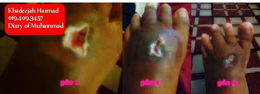 Kandungan gula dan toksik yang semakin meningkat di dalam darah menyebabkan sel darah terganggu. Penawar Kencing Manis Yang Terbaik Untuk Luka Lambat Sembuh Diary Of Muhammad