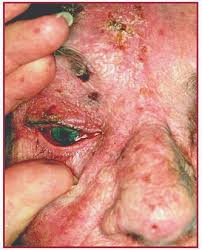 Image result for herpes zoster