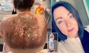 Mum has to go to hospital with sunburn despite wearing suncream