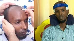 Somali people to be on the taller side of the spectrum. Somaliland Turkish Medics Eliminating Baldness Among Men In Menafn Com