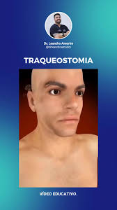 Como funciona a traqueostomia? ❓ A traqueostomia é um procedimento  cirúrgico em que uma abertura é feita na traqueia para facilitar a  respiração. 🫁💨 🔹 Um tubo é inserido no orifício para manter a via ...