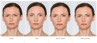Botox Cosmetic Maui Botox Medispa At Revitalizemaui
