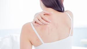 Cara menghilangkan biang keringat dengan obat kimia. Cara Mengatasi Bekas Gatal Menghitam Karena Digaruk