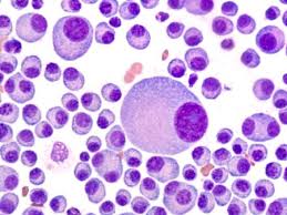 Multiples Myelom Neue Therapieansatze