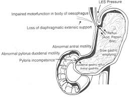 Gastroesophageal Reflux Disease Gastroesophageal Reflux Disease Reflux Disease Reflux