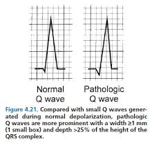 Despite general reliance on these ecg findings, there have been no recent studies to assess the predictive value of the q waves in inferior leads for the diagnosis of inferior wall myocardial infarction. Pin By Mellissa Begeman On Cardio Nurse Practitioner School Nursing Memes Pa School