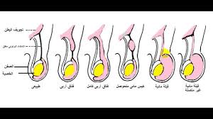 الخصية المعلقة وطرق العلاج موسوعة دار الطب