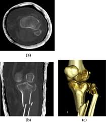 Dalrymple, md ● srinivasa r. Multi Detector Computed Tomography Assessment Of The Tibial Plateau Fractures Sciencedirect