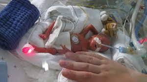 Baby Liegt 2 Wochen Tot Im Mutterleib B Z Berlin