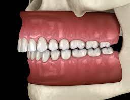 How do you fix an underbite without surgery? Overbite Underbite And Crossbite What Do These Bite Disorders Mean