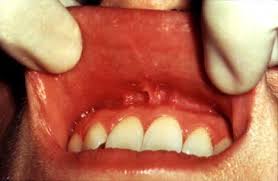 Image result for Labial mucosa