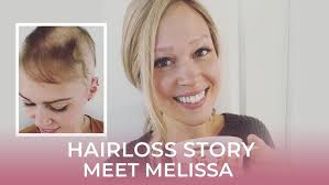 My Alopecia Journey Part 1