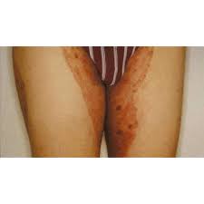 Noda hitam bisa terjadi karena bekas jerawat atau karena kosmetik yang tidak cocok. Krim Gatal Kulit 100 Berkesan Panau Kudis Jerawat Jeragat Parut Buy 5 Free1 Shopee Malaysia