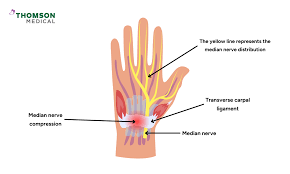 Image result for Carpal Compression Test