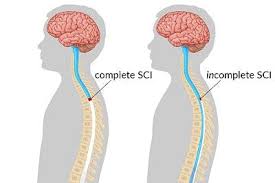 Image result for Spinal Trauma