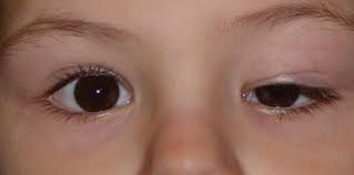  rasa sakit pada mata atau di sekitar salah satu mata. Kirat Na Mata Ng Batang Lalake Ay Sintomas Ng Nakamamatay Na Sakit