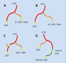 It is a paired artery, with one running along each side of the sternum, to continue after its bifurcation as the superior epigastric and musculophrenic arteries. Composite Y Grafting Using The Left Internal Thoracic Artery Survival And Angiography In 198 Cases Heart Lung And Circulation