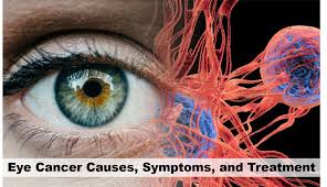 The cancerous cells in the melanoma are known as melanocytes that give certain pigment or colouring. Eye Cancer Causes Symptoms And Treatment First Health Station