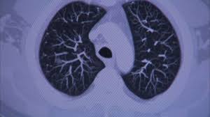 Finding these cancers in people without symptoms is rare and usually accidental (while doing tests to check for other medical problems). Lung Cancer Screening Mayo Clinic Youtube