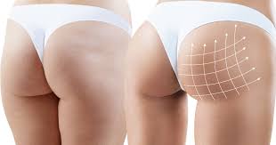 Fat transfers are used in a wide array of different areas. Pros Cons Of Brazillian Butt Lift Dr Tattelbaum