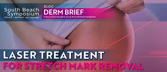 The fractional co2 laser is commonly used for. Laser Treatment For Stretch Mark Removal Livderm Blog
