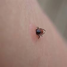 How To Remove A Tick - Healthychildren.org
