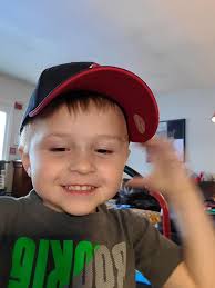 Hi! I'm not a doctor, or suggesting there is a connection, but I'm just  curious about the occurrence in this group of the "sugar bug" vein (across  the bridge of the nose)